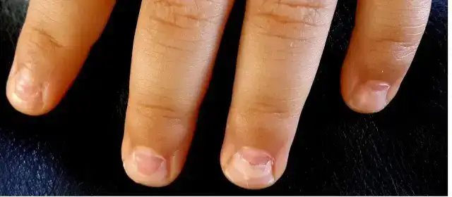 Peeling-Nails-Nails-Falling-Off-shedding-nails-Onychomadesis-hand-foot-and-mouth.webp