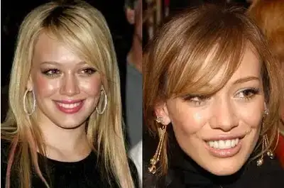 $hilary-duff-teeth-before-and-after.webp