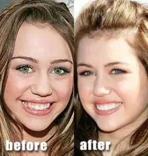 $miley-cyrus-before-after-teeth.webp