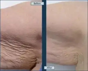 $vaser-liposelection-1.webp