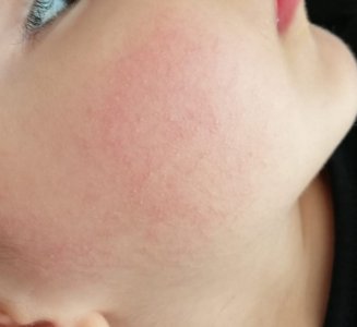 bebeklerde atopik dermatit alerjik egzama page 9 kadinlar kulubu