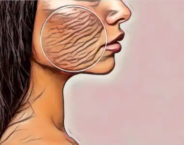 Farklı Mevsimlerde Atopik Dermatit Tedavisi Egzama Hakkında Bilmeniz Gerekenler