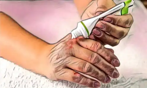 Farklı Mevsimlerde Atopik Dermatit Tedavisi Egzama Hakkında Bilmeniz Gerekenler
