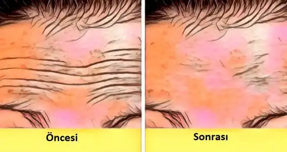 alin_cizgilerini_kirisikliklarini_azaltan_dogal_maske_tarifi.jpg alin_cizgilerini_kirisikliklarini_azaltan_dogal_maske_tarifi.jpg