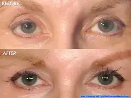 $eyelash_transplant_bauman(frontopen)_250.webp