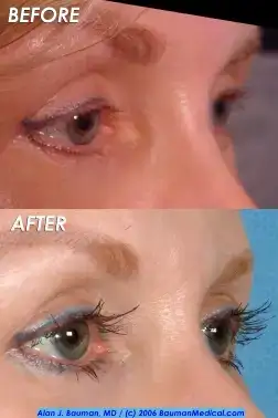 $eyelash_transplant_bauman(sideopen)_250.webp