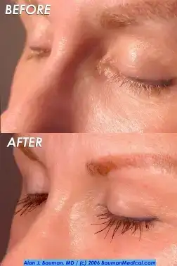 $eyelash_transplant_bauman(sideclosed)_250.webp