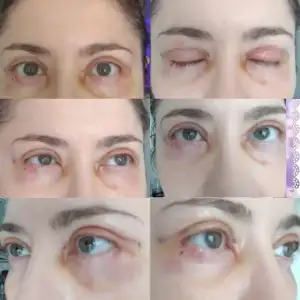 Goz Kapagi Estetigi Ameliyatim Prof Dr Sevim Cakmak Kadinlar Kulubu Goz Kapagi Estetigi Ameliyatim Prof Dr Sevim Cakmak Kadinlar Kulubu
