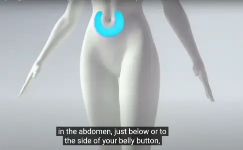 İğne bölgesi.webp