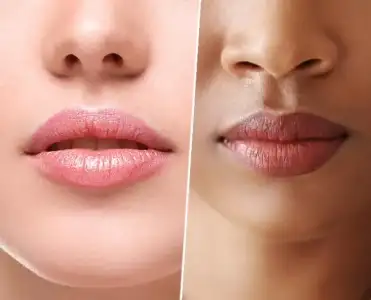 Evde Dudak Pigmentasyonu Nasıl Tedavi Edilir?