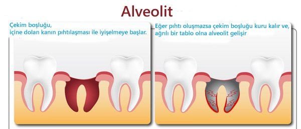 What is alveolitis? Alveolitis Symptoms and Treatment After Tooth Extraction
