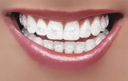 $ceramic-braces.webp