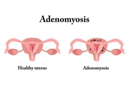 adenomyosis.jpg