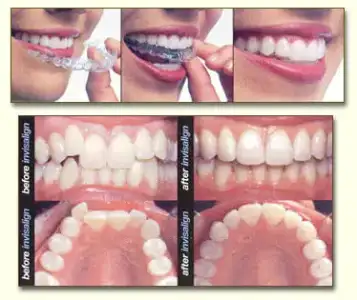 $Invisalign (1).webp