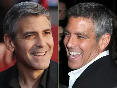 $George-Clooney-teeth-before-after-cosmetic-dentistry.webp