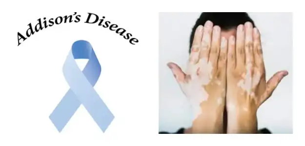 Addison hastalığı Nedir? Belirtileri Nelerdir?