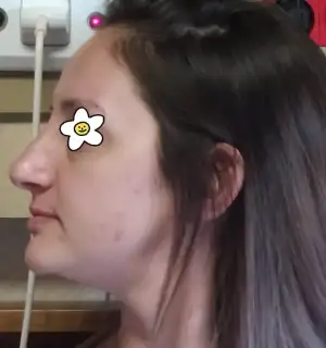 ameliyat öncesi 3.webp
