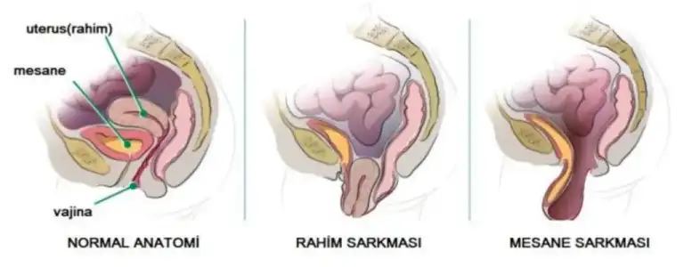 Histerektomi Sonrası Prolapsus Geliştirme Şansı.webp