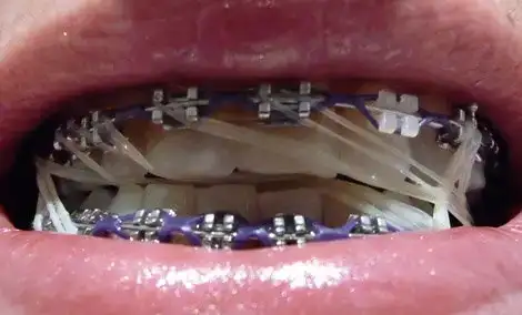 $lastikli a&#287;&#305;z.webp