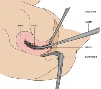 kurtaj_nedir_nasil_yapilir_neden_yapilir_sonrasi.webp