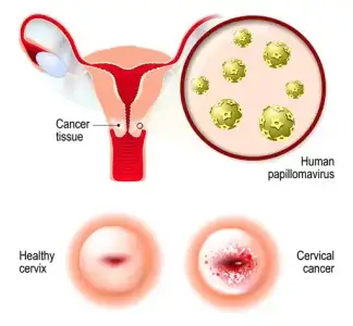 hpv_ve_pap_smear_testi.webp