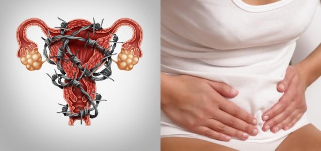 Endometriozis: Nedenleri, Belirtileri, Teşhis ve Tedavisi