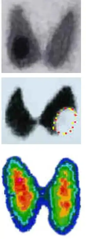 tiroid_taramasi_goruntuleri_sicak_soguk.jpg tiroid_taramasi_goruntuleri_sicak_soguk.jpg