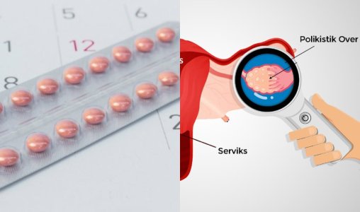 Doğum kontrol hapı, polikistik over sendromlu kadınlarda tip 2 diyabet riskini azaltabilir