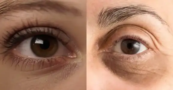 koyu_halkalar_evde_cozumu.webp