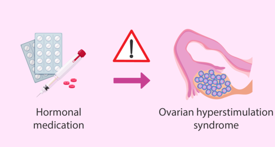 Ovaryan_Hiperstimulasyon_Sendromu.png