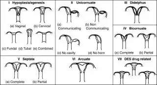 $uterus-abnormalities.webp