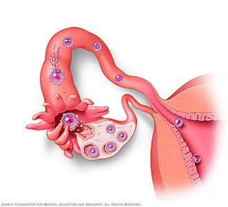 Endometriozis.jpg