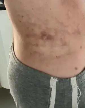Yahya Baltu liposuction 2.webp