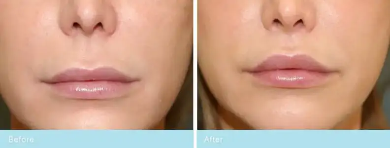 $BeforeAfter_Lip_Patient1.webp