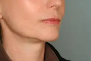 $285_Before_Lip_Lift.webp