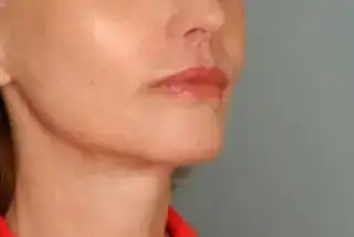 $286_After_Lip_Lift.webp