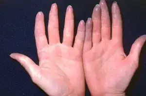 $Raynaud.webp