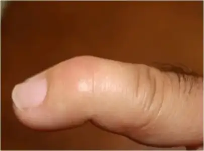 $malletfinger1.webp