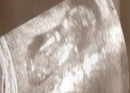 $ultrason 14 001.webp