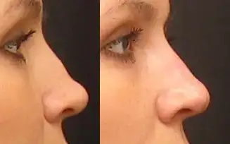 $Non-Surgical-Nose-Job-before-261549.webp