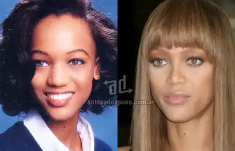 $Tyra-Banks_nariz-nosejob_www_antesydespues_com_ar.webp