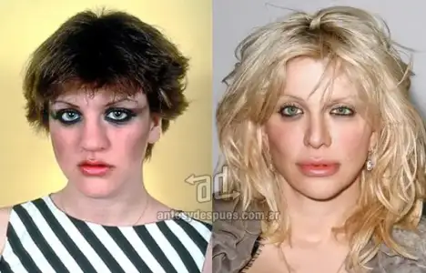 $Courtney-Love_nariz-nosejob_www_antesydespues_com_ar.webp