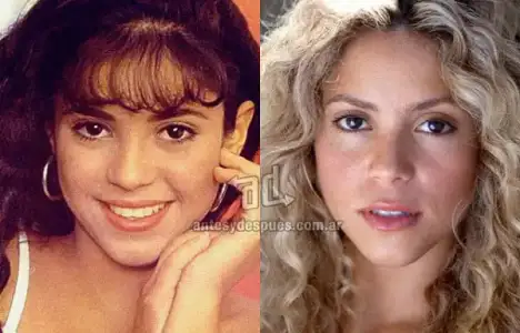 $Shakira_nariz-nosejob_www_antesydespues_com_ar.webp