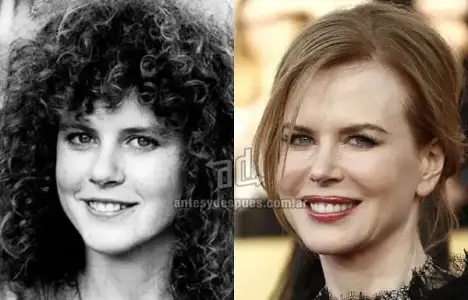 $Nicole-Kidman_nariz-nosejob_www_antesydespues_com_ar.webp