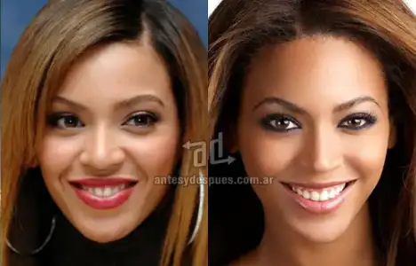 $Beyonce_nariz-nosejob_www_antesydespues_com_ar.webp