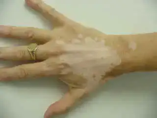 $vitiligo.webp $vitiligo.webp