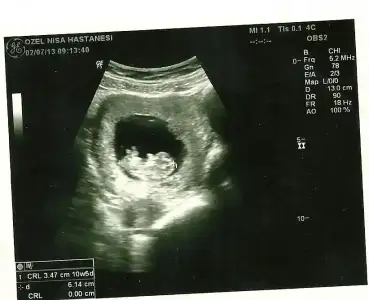 $bebegim 10 haftalÃ½k0000.webp