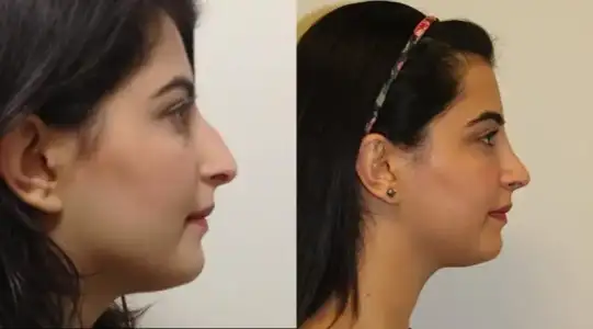 $önce sonra.webp $önce sonra.webp