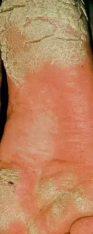 $keratoderma.webp