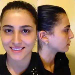 $&#246;nceki burnum.webp